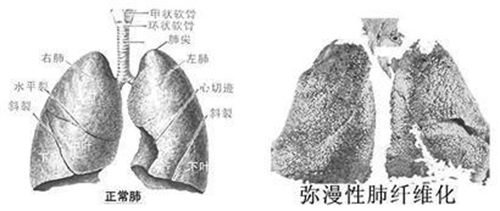 印度代购药：吡非尼酮-详细信息及使用知识等